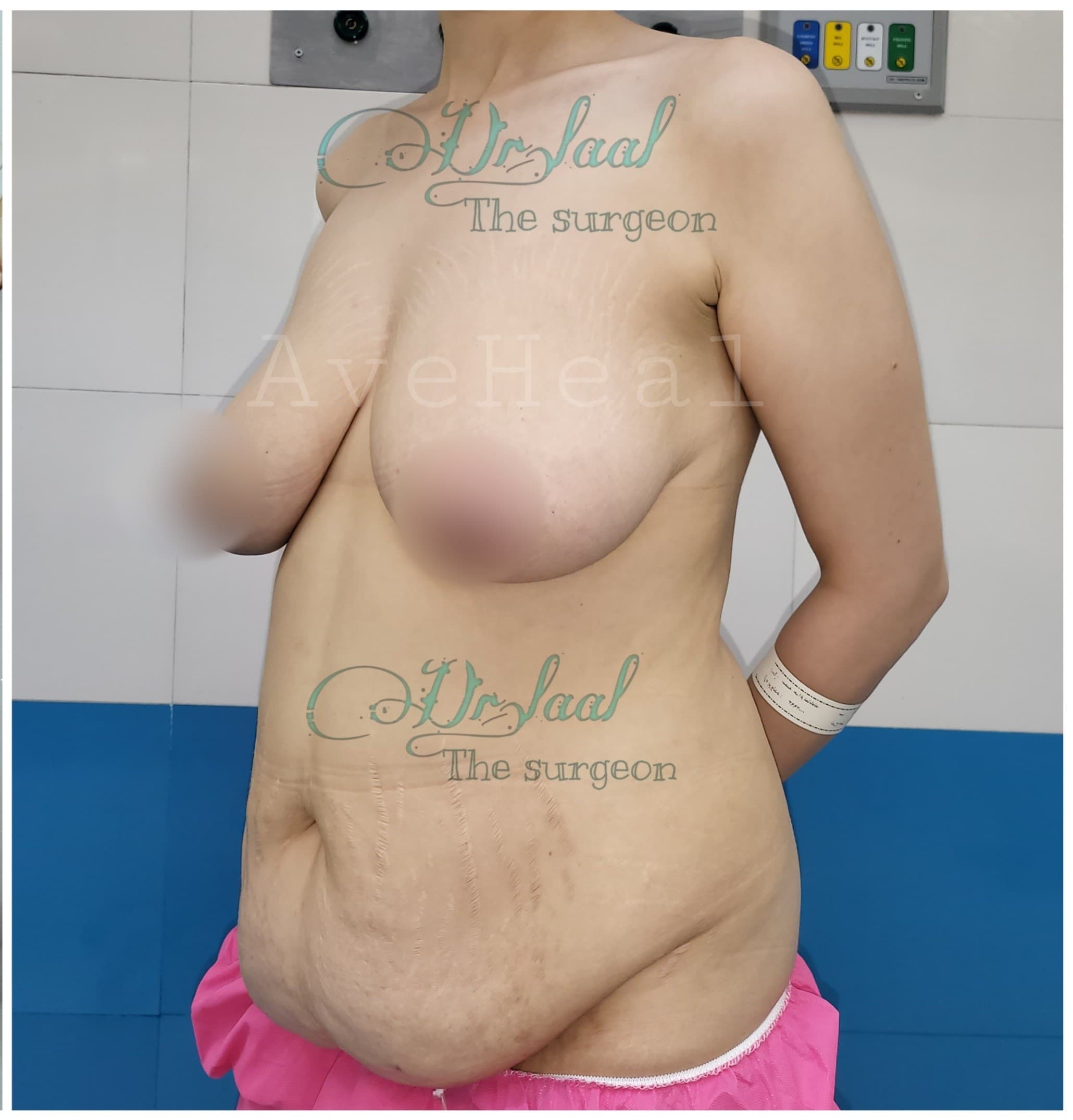 before-breast-lift-liposuction-abdominoplasty-dr-homeira-laal-khoshab